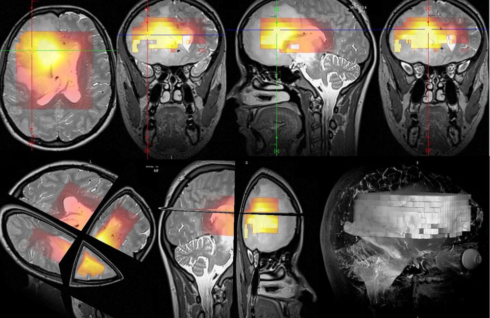 Biomedicínské technologie v neuroonkologii