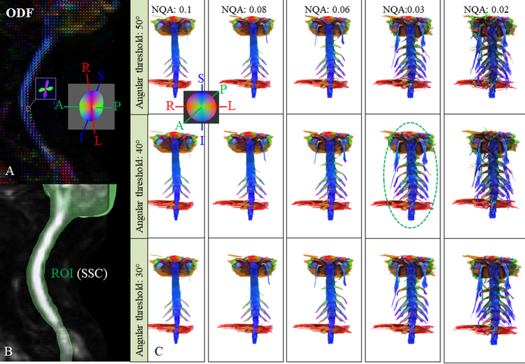 Magnetická rezonance - traktografie brachiálního plexu: krok za krokem