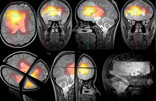 Biomedicínské technologie v neuroonkologii